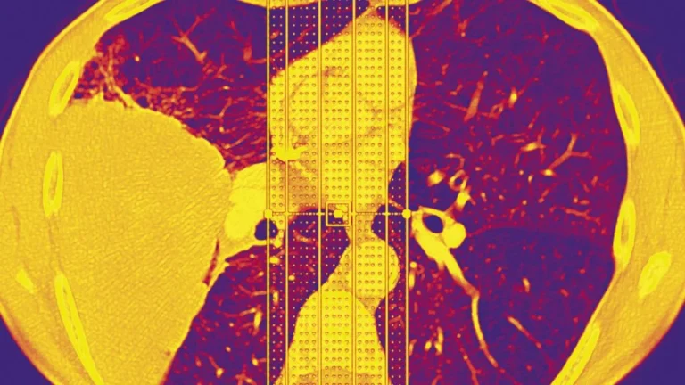 The Genetic Ghost: Unmasking a Rare Variant Driving Lung Cancer in Never-Smokers