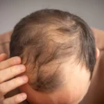The Genetic Link: New Research Ties Popular GLP-1 Weight-Loss Drugs to Increased Risk of Hair Loss
