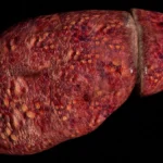 The Hidden Crisis: Why Younger Adults Face Accelerated Liver Failure from MASLD