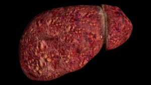 The Hidden Crisis: Why Younger Adults Face Accelerated Liver Failure from MASLD