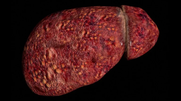 The Hidden Crisis: Why Younger Adults Face Accelerated Liver Failure from MASLD