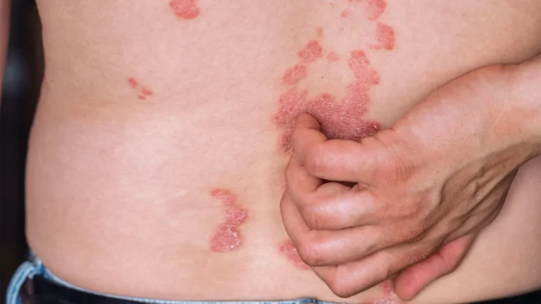 The Legal Landscape of GLP-1 Agonists in Dermatology: Navigating a New Frontier of Liability