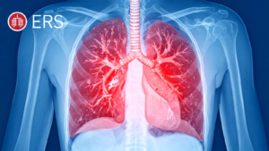 The Power of Joy: New Clinical Evidence Suggests Laughter Therapy Could Revolutionize COPD Management