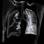 The Silent Crisis in Lung Biopsies: How Selio Medical Aims to Seal a Multimillion-Dollar Healthcare Gap