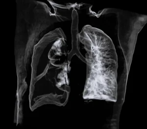 The Silent Crisis in Lung Biopsies: How Selio Medical Aims to Seal a Multimillion-Dollar Healthcare Gap