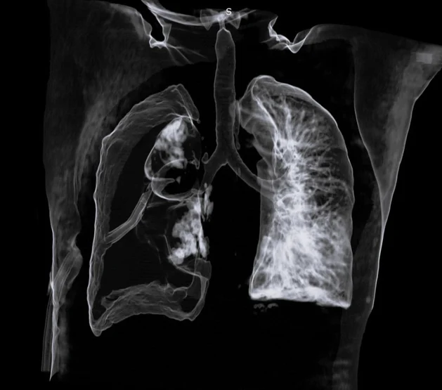 The Silent Crisis in Lung Biopsies: How Selio Medical Aims to Seal a Multimillion-Dollar Healthcare Gap
