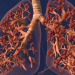 The Silent Infiltration: New Study Links Microplastic Accumulation to Lung Malignancy