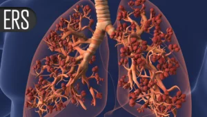 The Silent Infiltration: New Study Links Microplastic Accumulation to Lung Malignancy