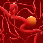 The Silent Rise: Understanding the Surging Prevalence of Unruptured Brain Aneurysms
