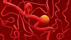The Silent Rise: Understanding the Surging Prevalence of Unruptured Brain Aneurysms