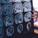 The Silent Saboteur: Redefining Alzheimer’s Through the Lens of Iron Overload