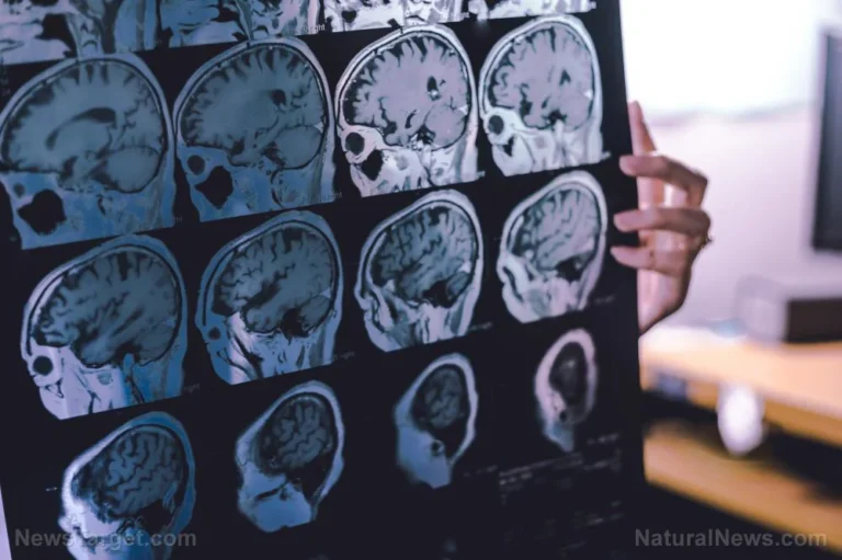 The Silent Saboteur: Redefining Alzheimer’s Through the Lens of Iron Overload