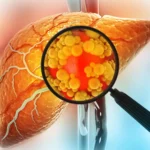 The "Sugar-Free" Mirage: New Research Challenges the Metabolic Safety of Sorbitol