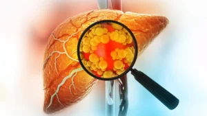 The "Sugar-Free" Mirage: New Research Challenges the Metabolic Safety of Sorbitol
