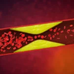 Unraveling the Genetic Blueprint of Blood Clots: New Insights into Venous Thrombosis