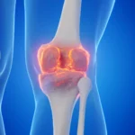 A Potential Breakthrough in Joint Health: Blocking a "Gerozyme" to Reverse Arthritis