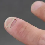 Beyond the Scale: Emerging Links Between GLP-1 Medications and Dermatological Changes