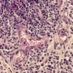 Clinical Setback: Artiva Biotherapeutics Halts NK Cell Therapy Trial Following Patient Deaths