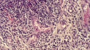 Clinical Setback: Artiva Biotherapeutics Halts NK Cell Therapy Trial Following Patient Deaths