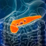 The Silent Sentinel: How AI Is Redefining the Fight Against Pancreatic Cancer