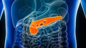 The Silent Sentinel: How AI Is Redefining the Fight Against Pancreatic Cancer