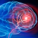 The Silent Surge: Why Strokes Are Targeting Younger Adults at Alarming Rates